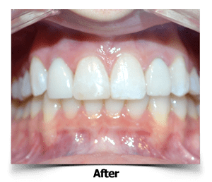 Lateral-Dental Porcelain Veneers After