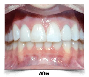 Lateral-Dental Porcelain Veneers After