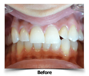 Lateral Dental Porcelain Veneers Before