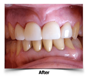 Anterior Dental Crowns After