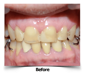 Anterior Dental Crowns Before