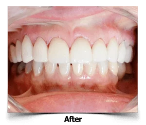 Dental Veneers After