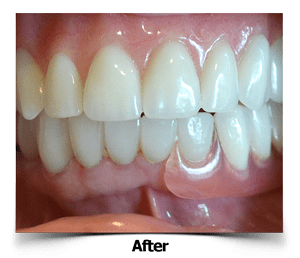 Dental Veneers Partial Denture After