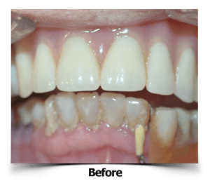 Dental Veneers Partial Denture Before