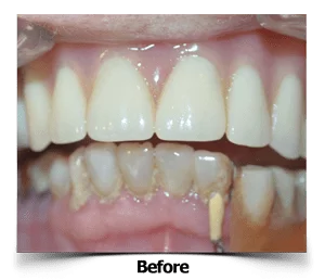 Dental Veneers Partial Denture Before