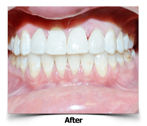 Lateral Veneers After