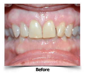 Lateral Veneers Before